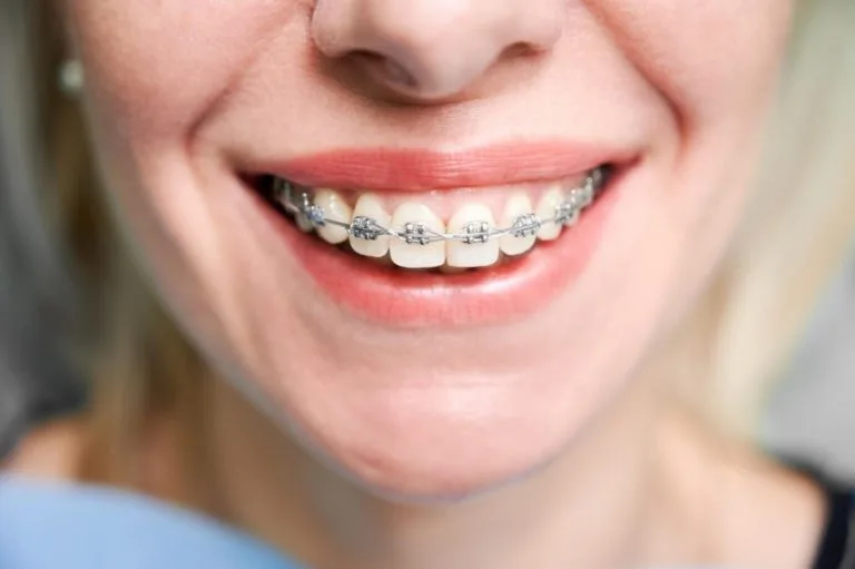 ¿Cuánto Cuesta Ponerse Brackets en USA? Precios Con/Sin Seguro